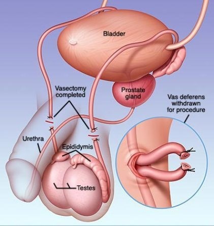 Thắt ống dẫn tinh - phương pháp triệt sản ở phái nam