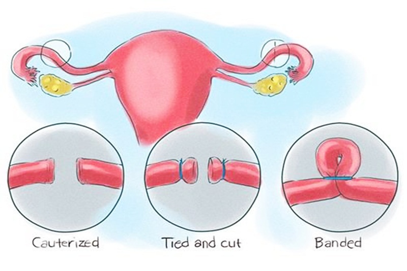 Thắt ống dẫn trứng - phương pháp tránh thai vĩnh viễn ở nữ giới