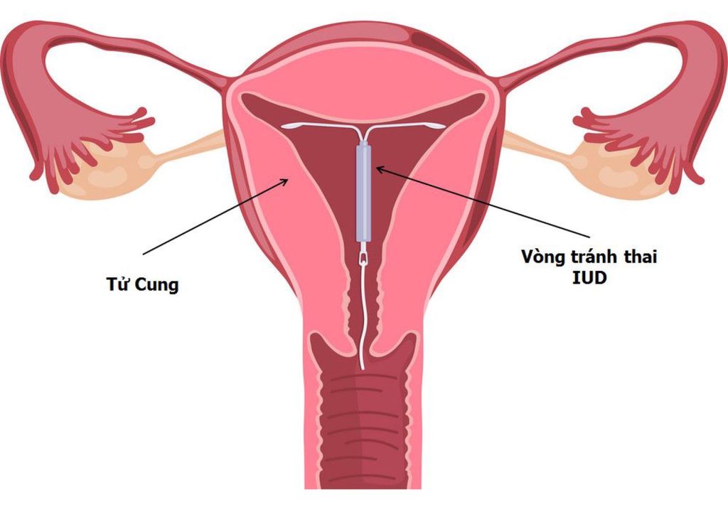 Phương pháp đặt vòng tránh thai