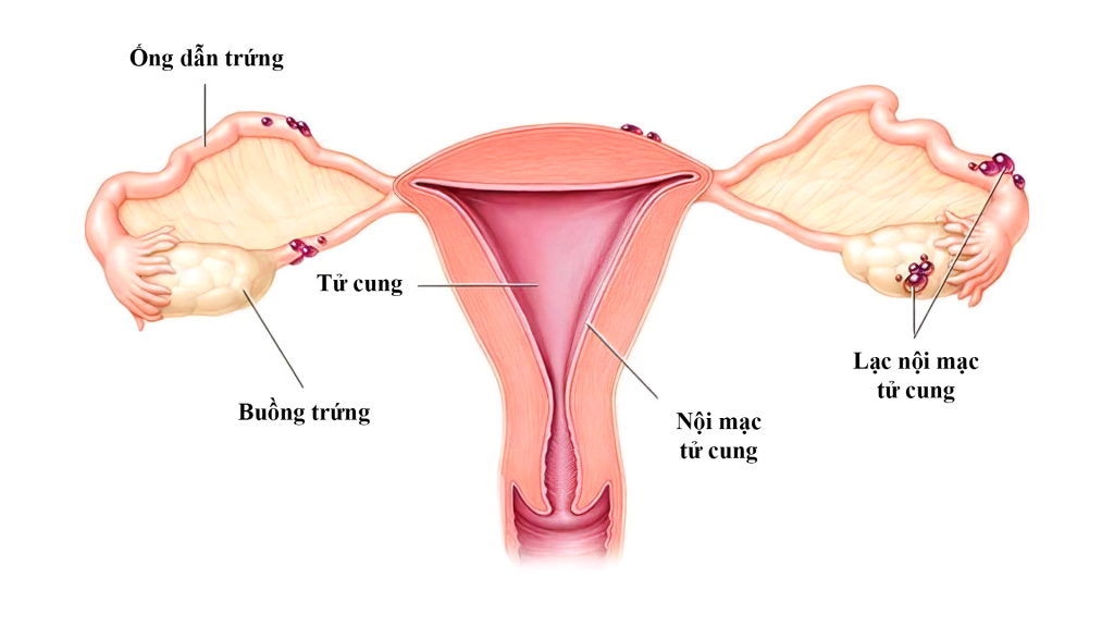 Lạc nội mạc tử cung hay còn gọi gọi là tuyến cơ tử cung