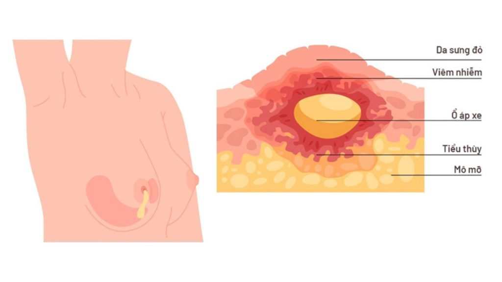 Cách điều trị áp xe vú hiệu quả cho phụ nữ sau sinh, Câu hỏi thường gặp liên quan đến bệnh áp xe vú, Áp xe vú sau sinh là gì? Nguyên nhân, Phân biệt tắc tia sữa với áp xe vú sau sinh