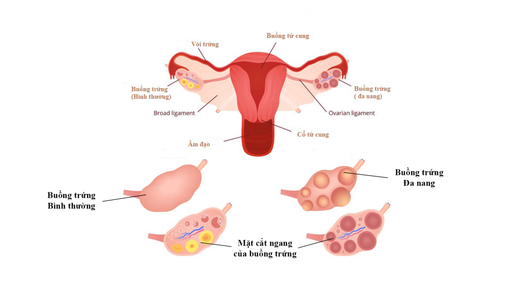 Tỷ lệ mắc hội chứng buồng trứng đa nang nagyf càng cao