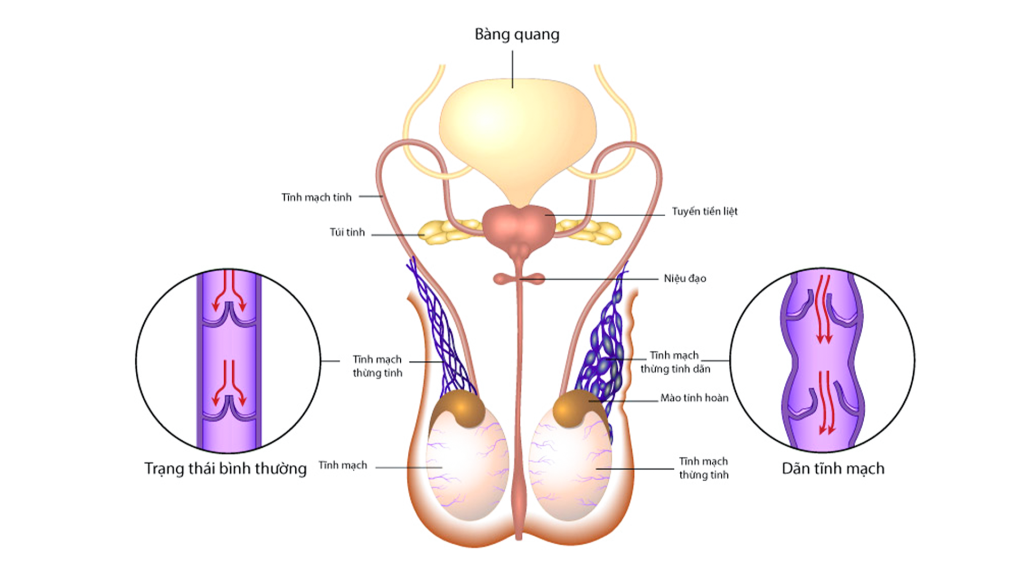 Giãn tĩnh mạch thừng tinh là một bệnh lý khá phổ biến