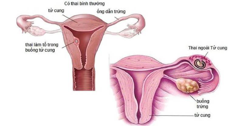 Mang thai ngoài tử cung, Mang thai ngoài tử cung có thể có con không, Dấu hiệu thai ngoài tử cung là gì, Chửa ngoài tử cung và phương pháp điều trị, Mang thai ngoài tử cung liệu có nguy hiểm