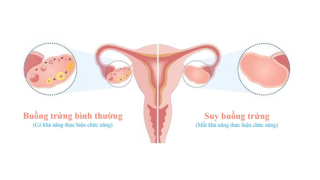 Điểm khác nhau giữa suy buồng trứng và buồng trứng bình thường