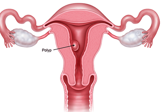 Polyp buồng tử cung và ảnh hưởng đến sức khỏe sinh sản như thế nào?