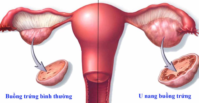 U nang buồng trứng là các khối u hoặc túi chứa dịch hình thành trong buồng trứng, một cơ quan sinh sản quan trọng của phụ nữ