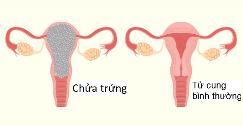 Chửa trứng (thai trứng) - nguyên nhân và nguy hiểm như thế nào?