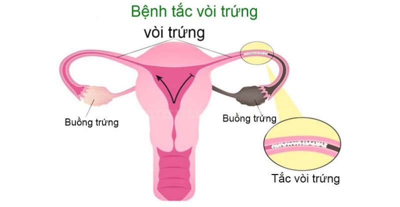 Tắc vòi trứng - Dấu hiệu nhận biết và cách xử trí 