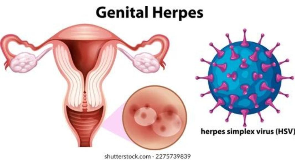 Herpes - Dấu hiệu nhận biết và phòng ngừa