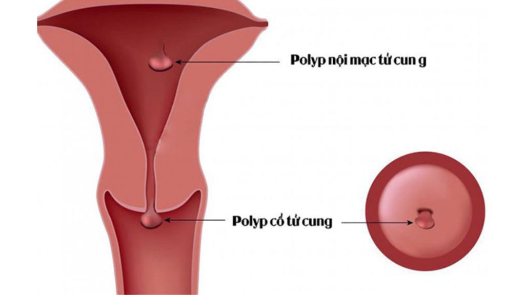 Polyp cổ tử cung là gì? Dấu hiệu nhận biết, nguyên nhân và phòng ngừa