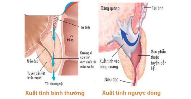 Những ai sẽ bị xuất tinh ngược dòng