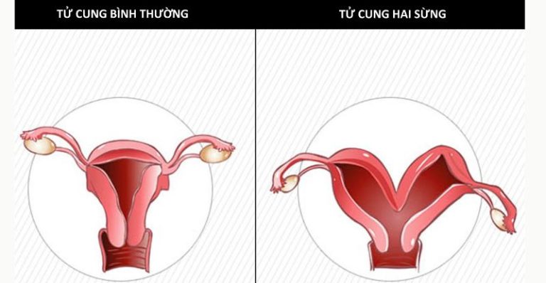 Tử cung hai sừng: Nguyên nhân và cách điều trị