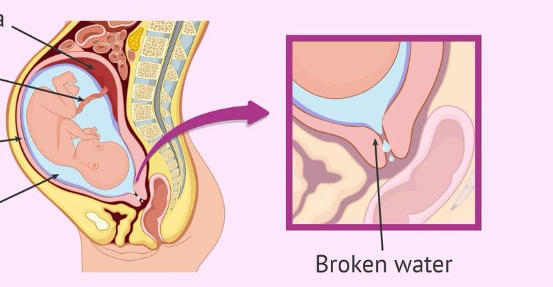 Tìm hiểu nguyên nhân rỉ ối, dấu hiệu và phòng ngừa