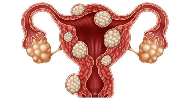 Nhân xơ tử cung có nguy hiểm không?