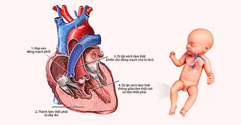 Thời điểm phát hiện bệnh tim bẩm sinh ở thai nhi?