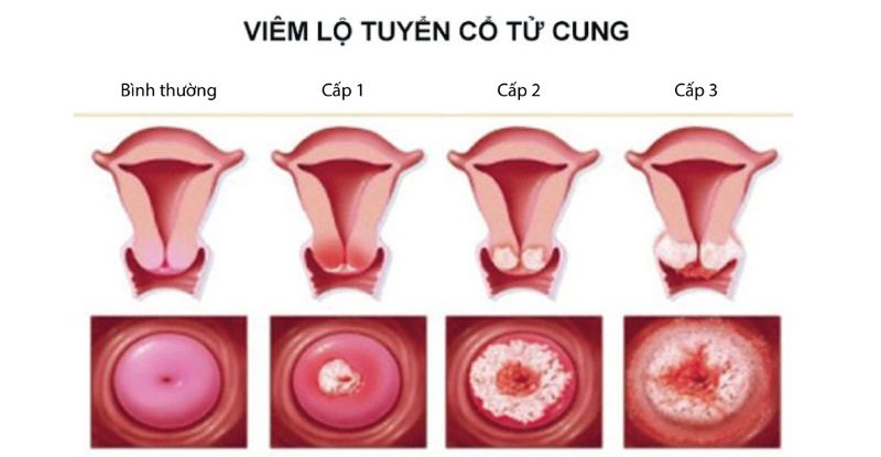 Viêm lộ tuyến có mang thai được không?