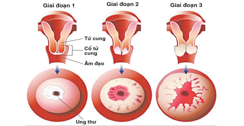 Tầm quan trọng của việc tầm soát ung thư cổ tử cung định kỳ