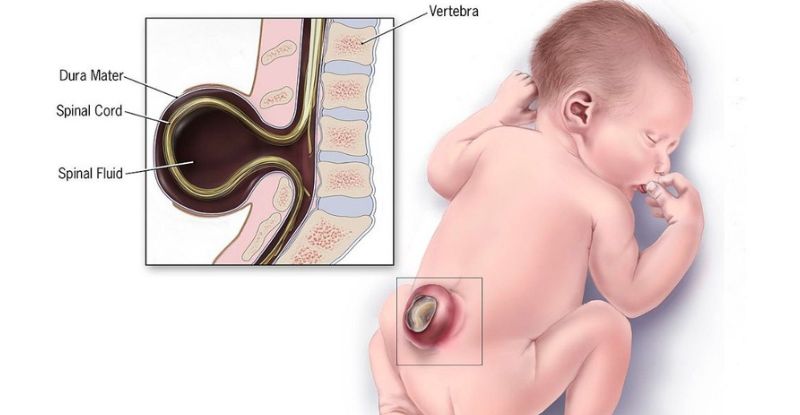 Tật cột sống chẻ đôi ở thai nhi: Nguyên nhân, phân loại và cách phát hiện